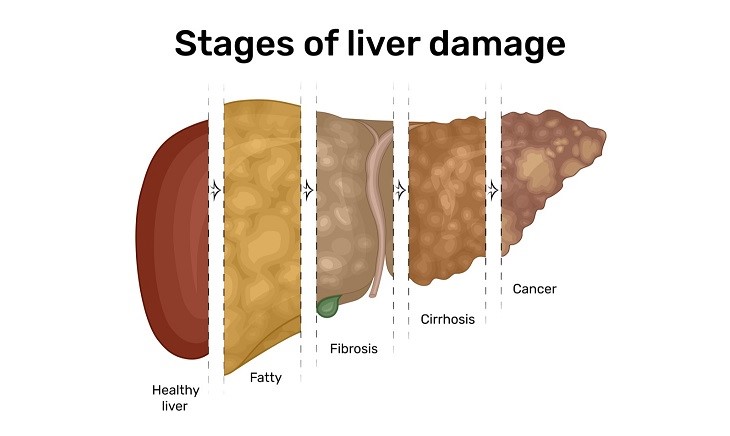 肝臓の症状遷移イメージ図　５．胆汁酸とグネチンC