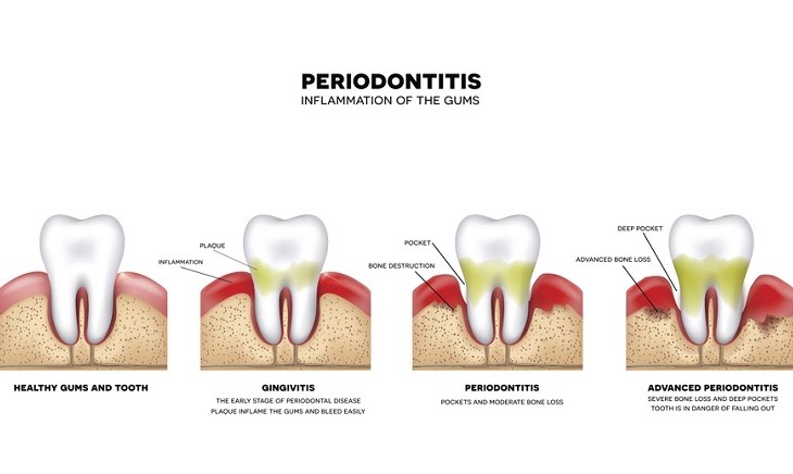 歯周病の変移イメージ図　８．炎症とグネチンC