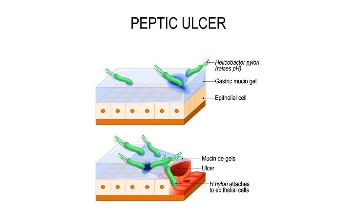 ムチン層の薄化による細菌侵入イメージ図　６．腸内細菌とグネチンC