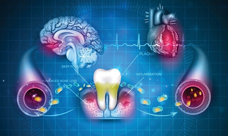 歯周病菌の侵入、各器官への拡散　１０．歯周病とグネチンC