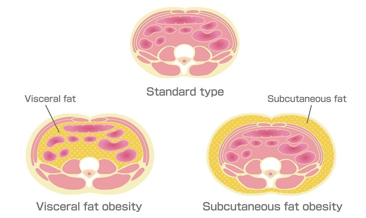 肥満のタイプ