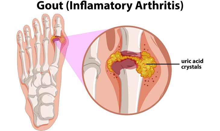痛風（炎症性関節炎）